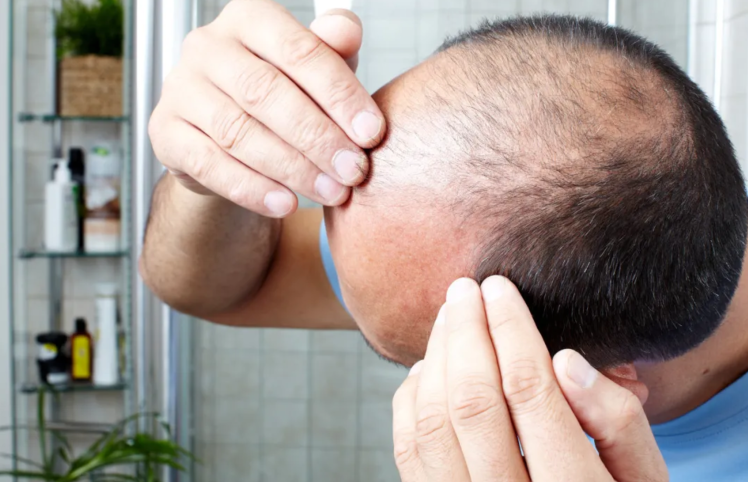 南京植發(fā)手術(shù)需要多少錢