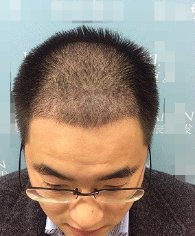 植發(fā)術(shù)后10天