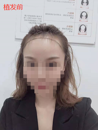 女生發(fā)際線植發(fā)1800單位，看看在南昌大麥微針植發(fā)后的恢復(fù)效果