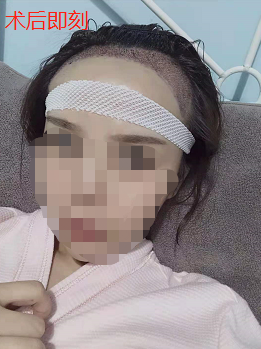 女生發(fā)際線植發(fā)1800單位，看看在南昌大麥微針植發(fā)后的恢復(fù)效果