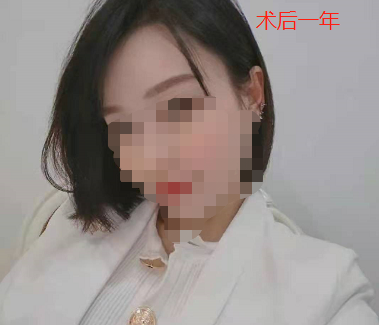 女生發(fā)際線植發(fā)1800單位，看看在南昌大麥微針植發(fā)后的恢復(fù)效果