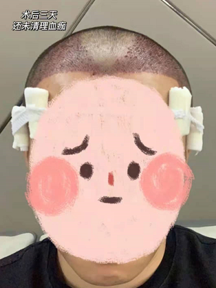 雍禾植發(fā)3200毛囊單位后，讓大家看看植發(fā)前后對比