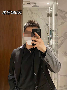 雍禾植發(fā)3200毛囊單位后，讓大家看看植發(fā)前后對比