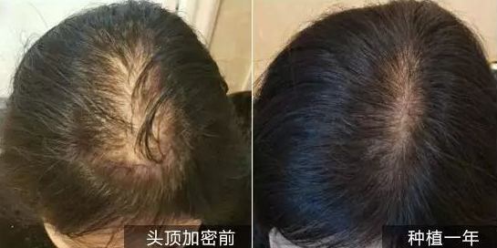 女性植發(fā)手術效果怎么樣呢？上海新生植發(fā)頭頂加密2500單位