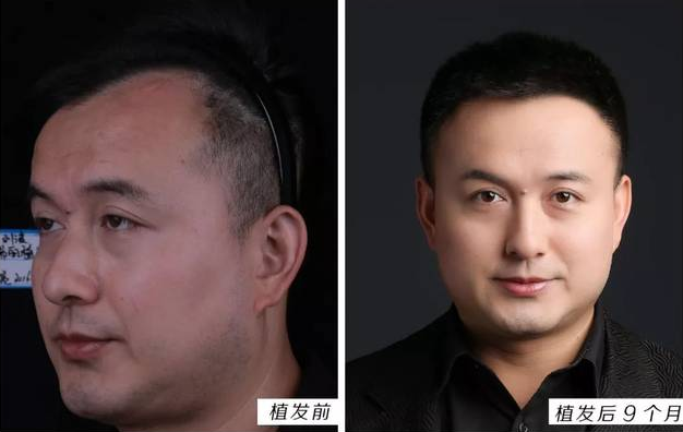 南昌植發(fā)怎么樣？南昌大麥微針植發(fā)2000單位效果分享