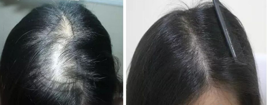 沈陽(yáng)牛大夫頭頂加密植發(fā)1800單位，看一年后術(shù)后效果怎么樣