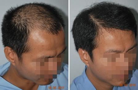 重慶仁愛植發(fā)案例，植發(fā)前后對比效果