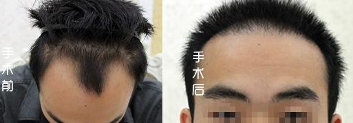 天津新發(fā)現(xiàn)植發(fā)多少錢，分享1800單位發(fā)際線植發(fā)手術(shù)后效果
