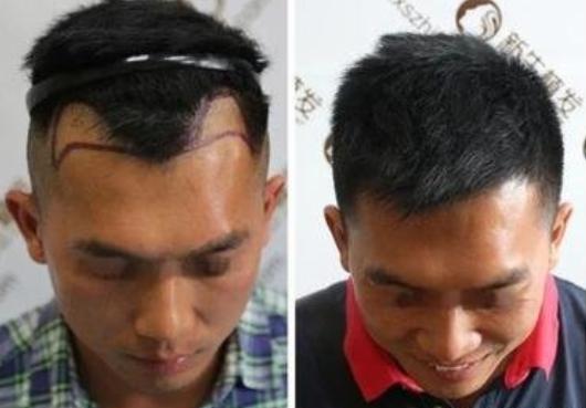 廣州新生植發(fā)貴不貴，結合真實植發(fā)案例效果分享