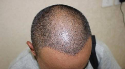 福州海峽植發(fā)醫(yī)院