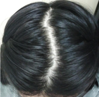 怎么把頭頂發(fā)縫變“窄”？發(fā)縫為什么會(huì)變“寬”？