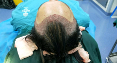 蘭州植發(fā)醫(yī)院排行榜名單公示，附植發(fā)價格表