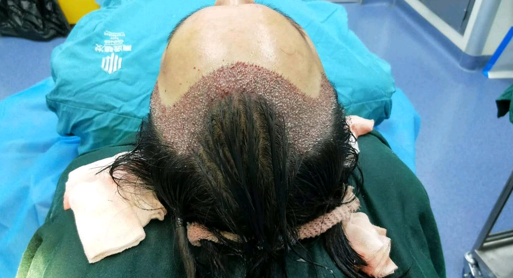 蘭州植發(fā)醫(yī)院排行榜