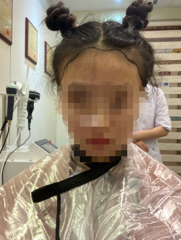 成都絲恒發(fā)際線植發(fā)1850單位案例分享，希望我的分享能幫到你