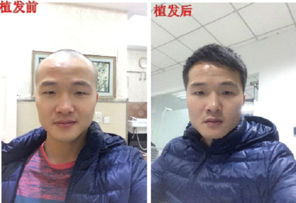 廣州植發(fā)貴不貴？廣州新生植發(fā)3000單位前后對(duì)比