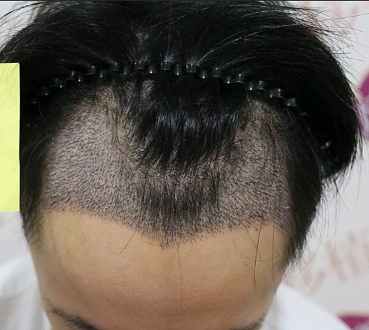 武漢中山醫(yī)院植發(fā)案例