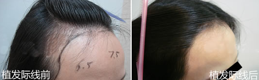 杭州大麥微針植發(fā)醫(yī)院怎么樣?發(fā)際線種植效果好嗎?