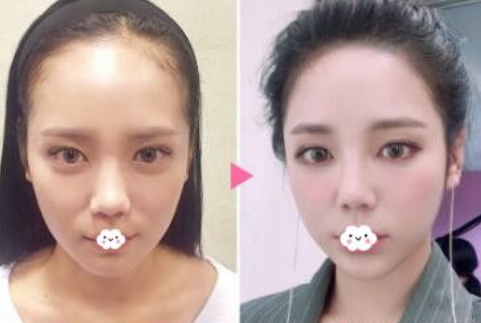 杭州大麥微針植發(fā)靠譜嗎?附地址_醫(yī)生介紹_加密種植效果_價格表