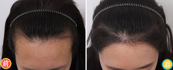 天津植發(fā)醫(yī)院排名|新發(fā)現(xiàn)、雍禾、大麥微針、熙朵上榜!附植發(fā)際線案例