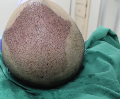 昆明植發(fā)醫(yī)院排名前五|碧蓮盛植發(fā)、人民醫(yī)院、雍禾植發(fā)植發(fā)等上榜!