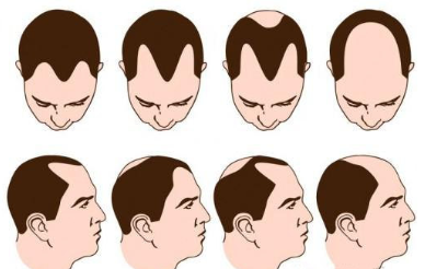 唐山哪個公立醫(yī)院可以植發(fā)?附植發(fā)價格表