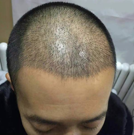 盤點太原哪里植發(fā)植的好?附禿頂植發(fā)經(jīng)歷分享