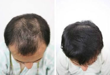 北京八大處醫(yī)院毛發(fā)移植中心怎么樣?植發(fā)多少錢?附價格表及植發(fā)效果圖