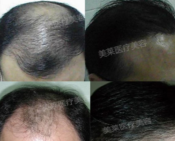 盤點長沙哪里植發(fā)植的好?附植發(fā)術后經歷分享