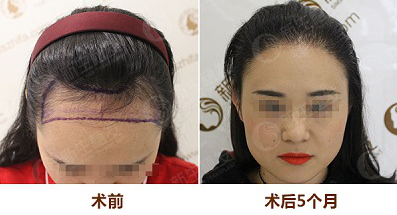 重慶植發(fā)哪里好|重慶正規(guī)植發(fā)醫(yī)院排名榜