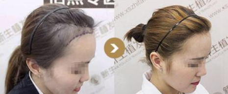 重慶新生植發(fā)怎么樣?附地址+植發(fā)醫(yī)生介紹+醫(yī)院價(jià)格表