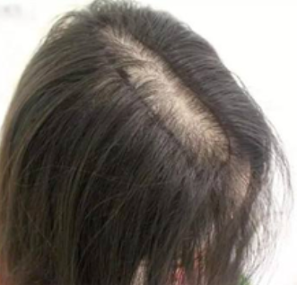 種植頭發(fā)費(fèi)用?種植頭發(fā)一根多少錢?