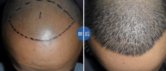 濟南海峽植發(fā)醫(yī)院靠譜嗎?頭頂加密種植效果好嗎?