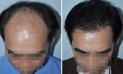 合肥叢生植發(fā)好不好?頭發(fā)種植效果如何?附植發(fā)價格表