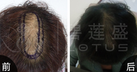 東莞碧蓮盛植發(fā)機(jī)構(gòu)可靠嗎?附醫(yī)生介紹_植發(fā)案例_價(jià)目表