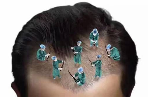 植發(fā)靠不靠譜，植發(fā)后的效果一般能維持多久