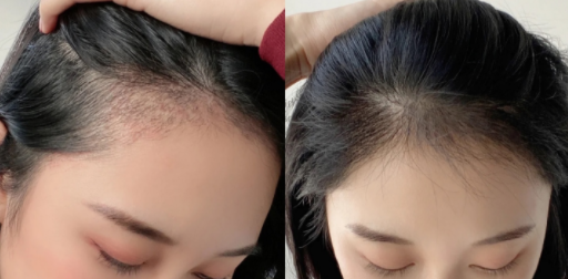 成都絲恒植發(fā)醫(yī)院地址在哪?附個人發(fā)際線種植經(jīng)歷分享