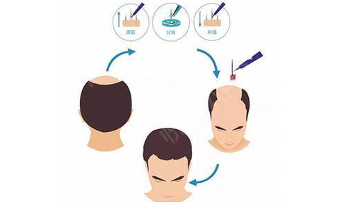 植發(fā)手術(shù)要多少錢?做完植發(fā)手術(shù)效果可以維持多久?