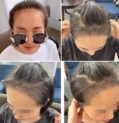 植發(fā)手術(shù)靠譜嗎?頭發(fā)移植手術(shù)安全嗎?