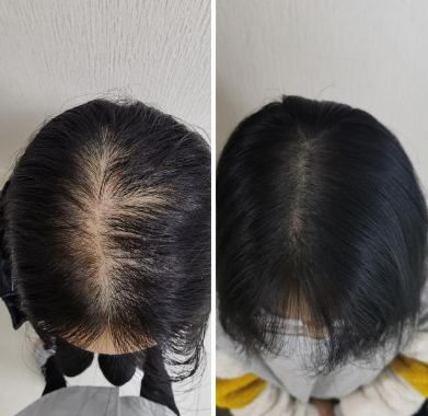 重慶仁愛植發(fā)醫(yī)院正規(guī)嗎?肖麗醫(yī)生怎么樣?附植發(fā)經(jīng)歷分享