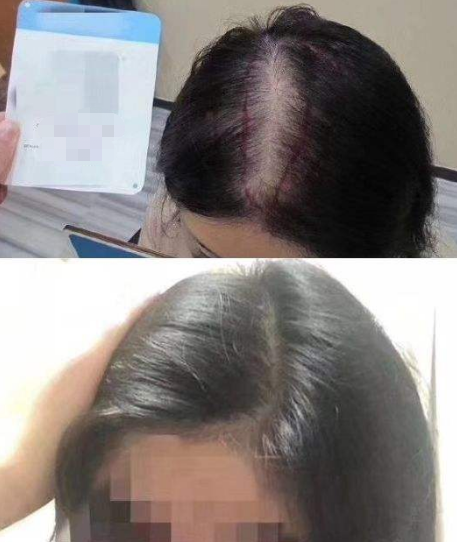 廣州新發(fā)現(xiàn)植發(fā)醫(yī)院怎么樣?附吳安利醫(yī)生介紹及發(fā)際線種植經(jīng)歷