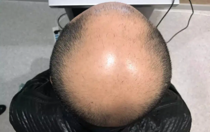 植發(fā)多少錢