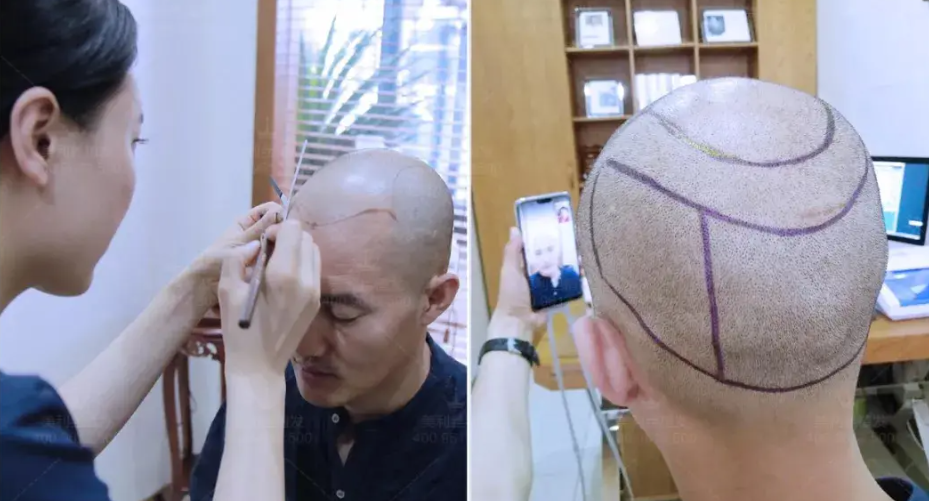 植發(fā)多少錢