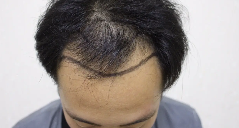 植發(fā)價(jià)格