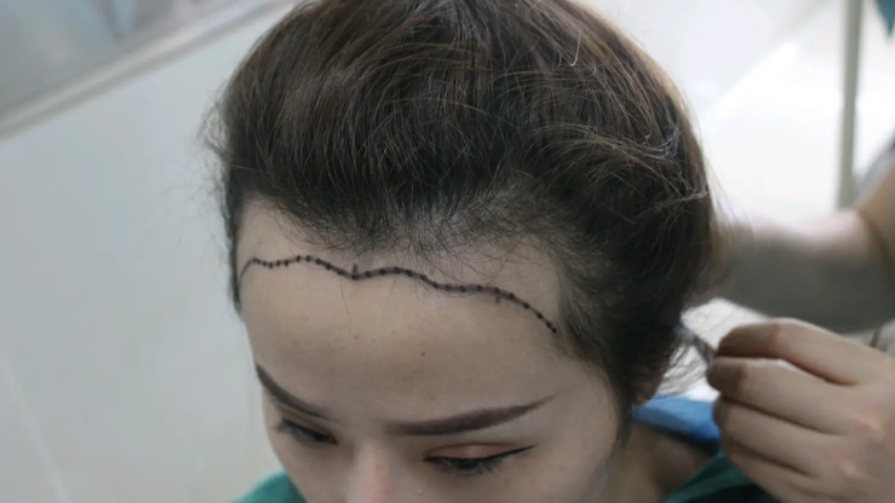 種植發(fā)際線多少錢