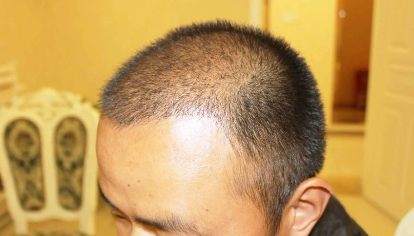 種植發(fā)際線效果