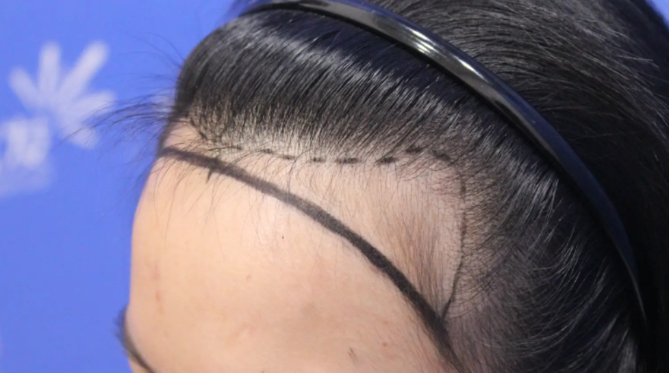 種植發(fā)際線攻略