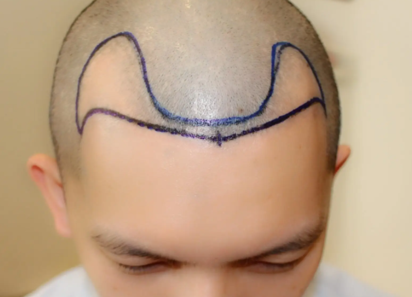 m型發(fā)際線植發(fā)多少錢