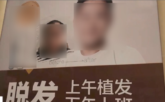 植發(fā)多少錢合適？植發(fā)技術(shù)哪個(gè)好？總結(jié)了10條植發(fā)前必讀的經(jīng)驗(yàn)！