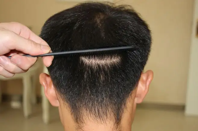 懷化口碑較好的植發(fā)醫(yī)院排名，來看看哪家植發(fā)醫(yī)院更好吧！