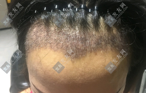 種頭發(fā)和植發(fā)一樣嗎